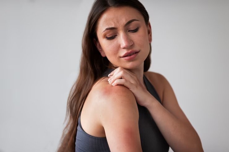 How You Can Treat Heat Rash Yourself