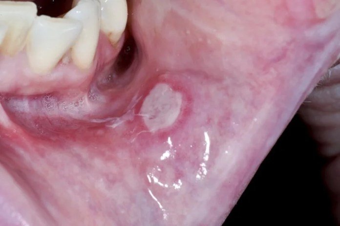 Causes And Treatment Of Mouth Ulcers