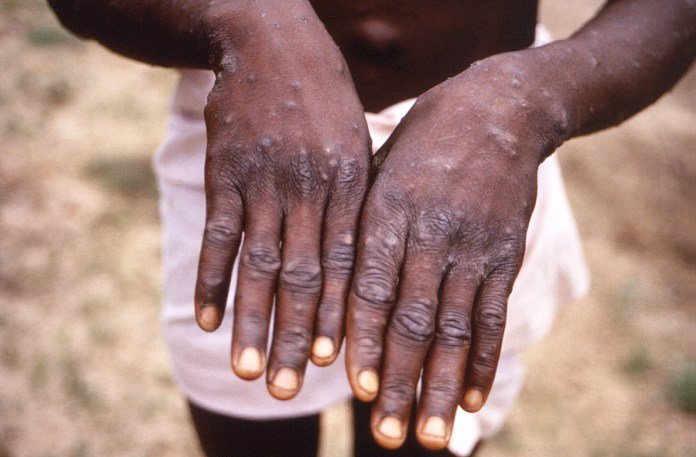 Symptoms And Treatment Of Mpox